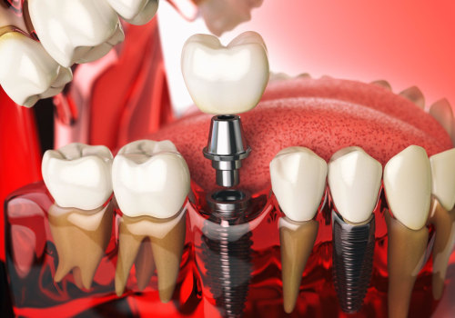 Exploring the Different Types of Dental Implant Materials