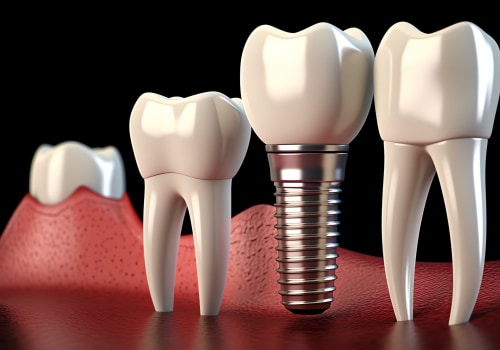 Understanding the Long-Term Success Rates of Dental Implants