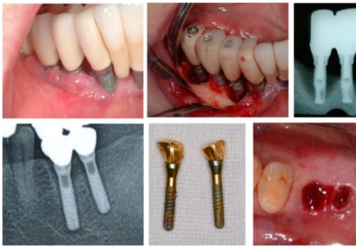 Causes of Implant Failure: Understanding the Risks