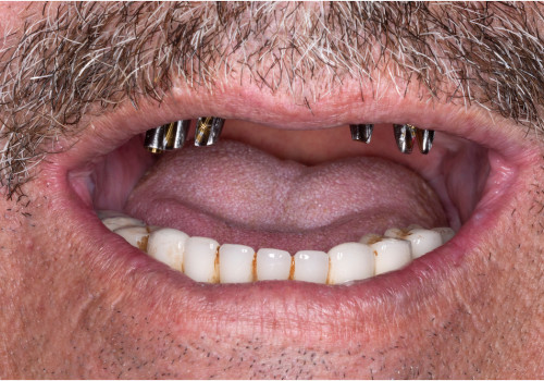 Pros and Cons of Dental Implants Compared to Other Options