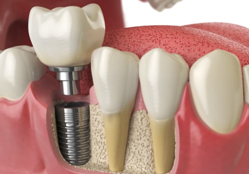 Attaching the Abutment to the Implant: A Comprehensive Guide