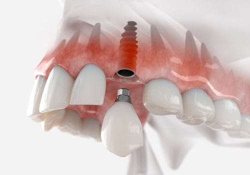 Dealing with Implant Failure: A Step-by-Step Guide