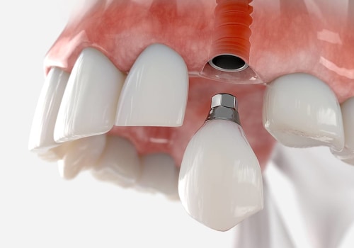 Placing the Final Crown on the Abutment: A Comprehensive Guide for Dental Implant Patients