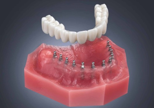 Exploring the Benefits of Mini Dental Implants