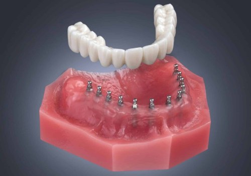 The Benefits and Options of Mini Dental Implants for Replacing Missing Teeth