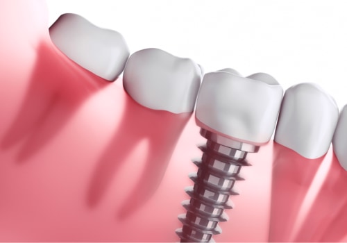The Cost of Dental Implants in the US: What You Need to Know