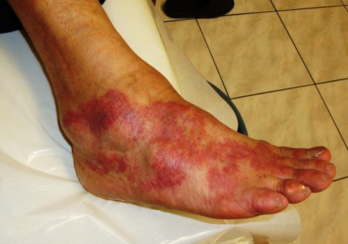 Causes and Symptoms of Infection or Inflammation