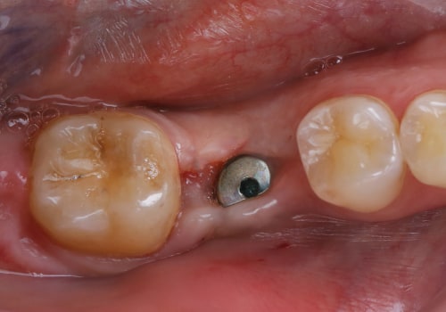 Surgical Procedure for Implant Placement: Everything You Need to Know
