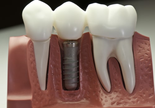 Preventing Infections After Implant Surgery: Everything You Need to Know