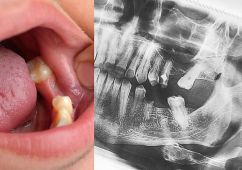 Cost of Implants in Europe: A Comprehensive Guide to Replacing Missing Teeth