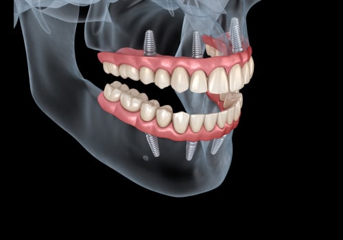 Creating a Treatment Plan for Dental Implants